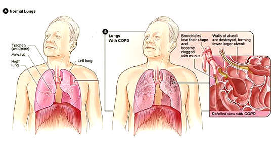 Oxygen Therapy Doesn’t Benefit Everyone With COPD Oxygen Therapy Doesn’t Benefit Everyone With COPD